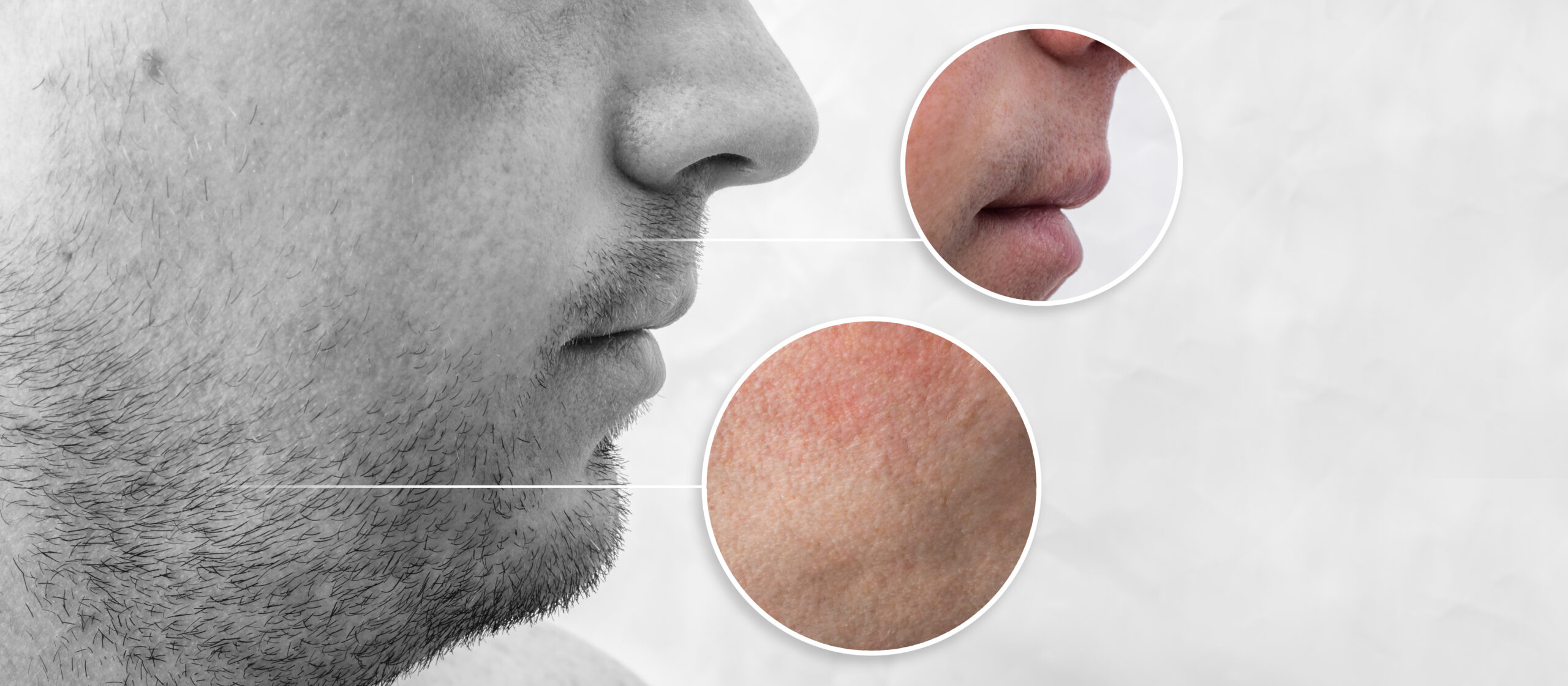 transplante de barba