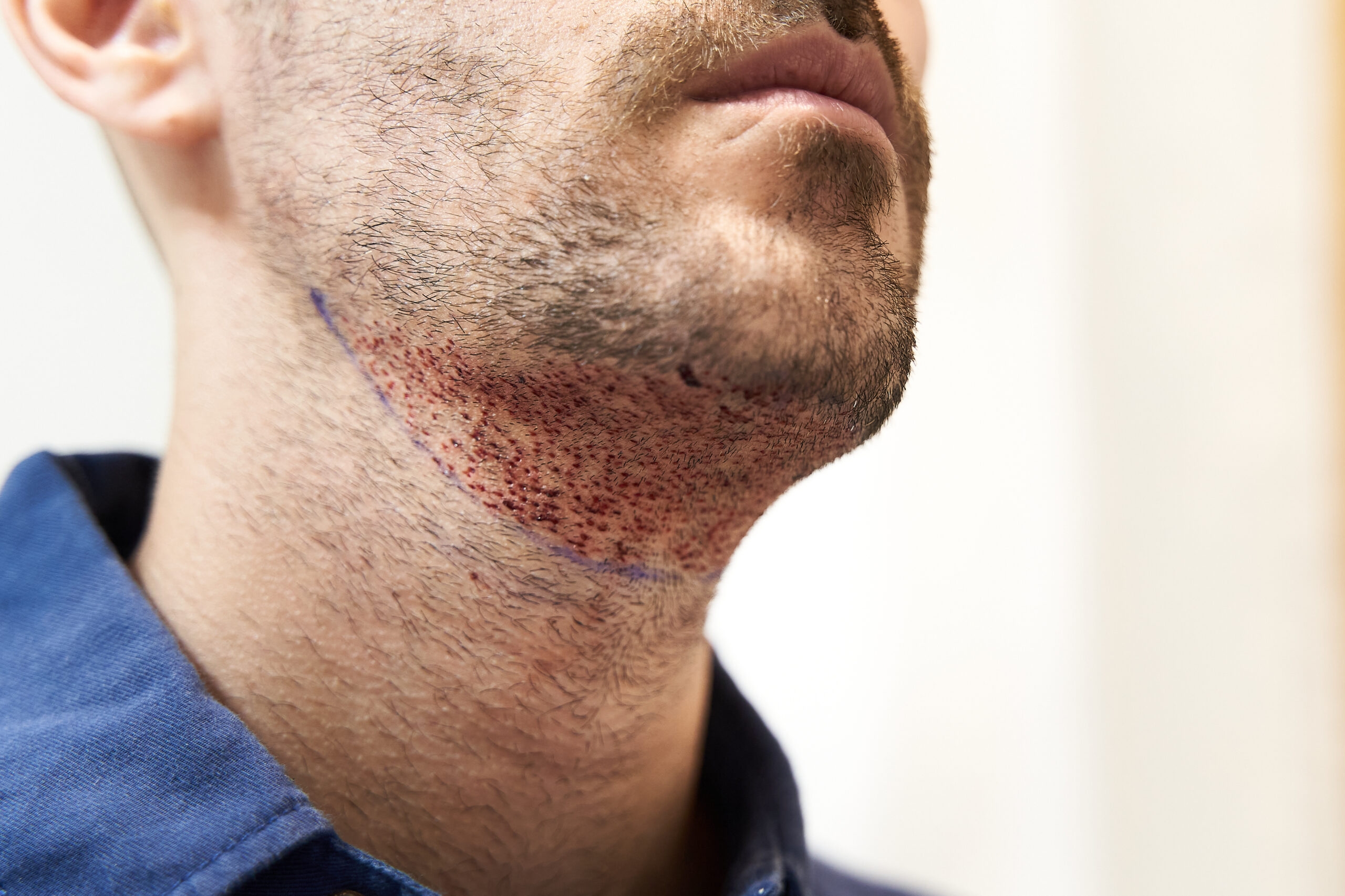 transplante de barba pós operatório