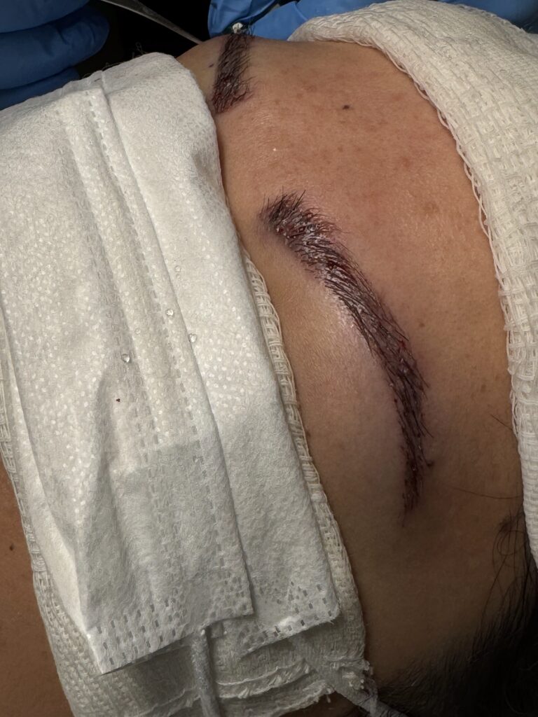 Transplante de Sobrancelhas